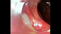 Endoscope 100cm deep anal insertion